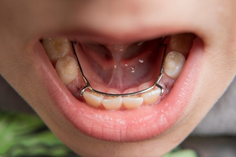 Space Maintainers in child's mouth - Montclair Pediatric Dentistry in Oakland